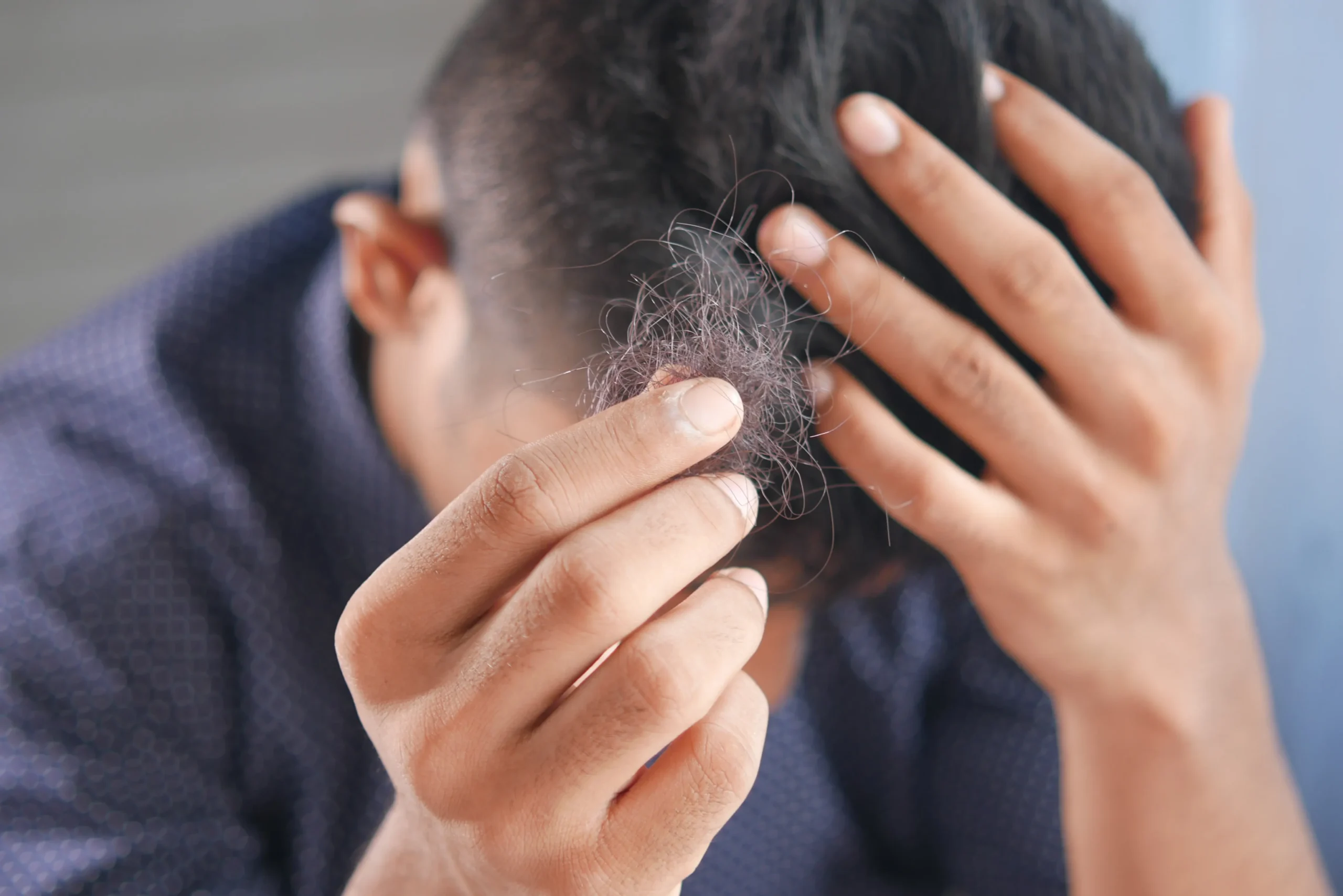 Can depression cause hair loss