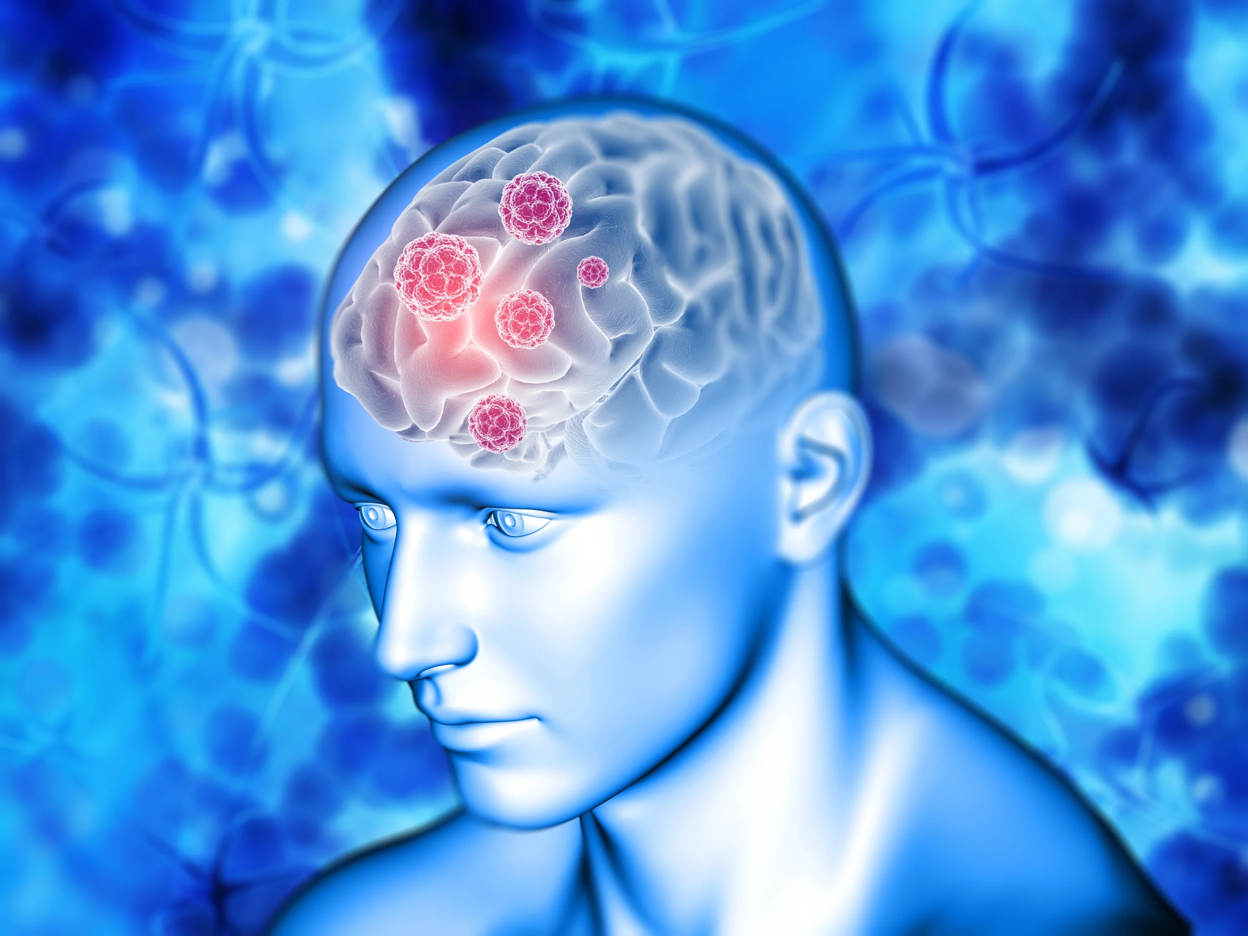 Can brain tumors cause depression
